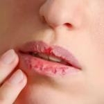 Cara Menjaga Kesehatan Bibir yang Kering dan Mengelupas, Yuk Simak!